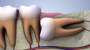 20’lik Diş ve Erken Müdahale Önemi