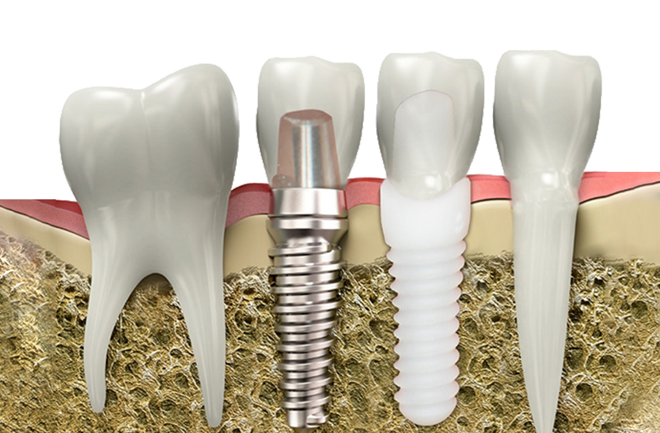 Dental İmplant Cerrahisi: Kayıp Dişlerin Kalıcı ve Güvenilir Çözümü