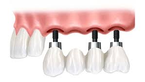 Diş İmplantı mı, Diş Köprüsü mü?