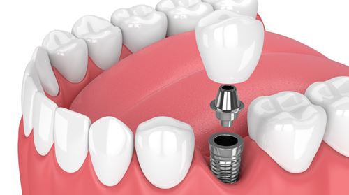 Diş İmplantları Biyoteknolojinin Neresinde?