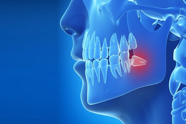 Gömülü Diş Operasyonları: Nedenleri, Süreci ve İyileşme Dönemi
