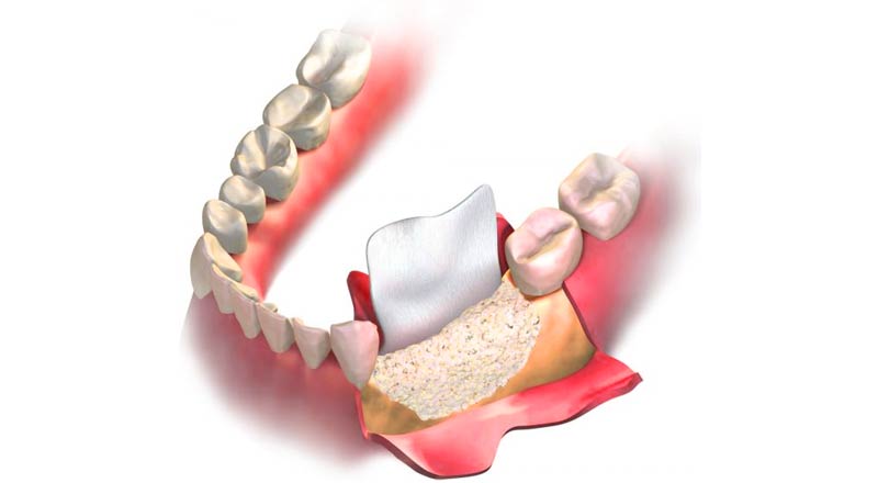 Kemik Erimesi Olanlar İmplant Yaptırabilir mi?