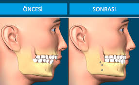 Ortognatik Cerrahi: Çene Bozukluklarının Estetik ve Fonksiyonel Çözümü