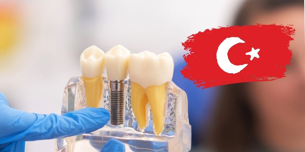 Türkiye’de İmplant Yaptırmak: Yabancılar Neden Burayı Tercih Ediyor?